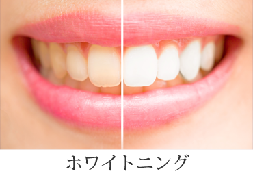 ホワイトニング